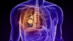 Lung cancer drug hits main goal in trial